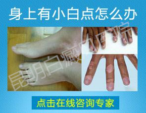 身上长白斑怎么回事,是什么病?怎么治? 身上长白斑怎么回事,是什么病?怎么治?