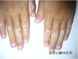 白癜风有哪些明显的症状