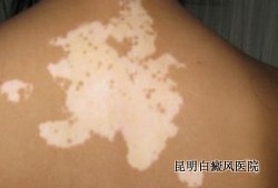 白癜风治疗要遵循哪些原则