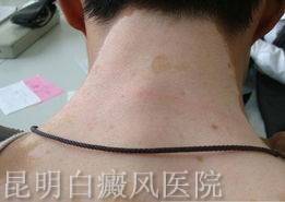 白癜风应该怎么治疗