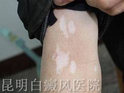 早期白癜风的治疗方法有哪些