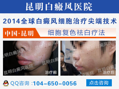 白癜风患者吃哪些食物缓解白癜风？