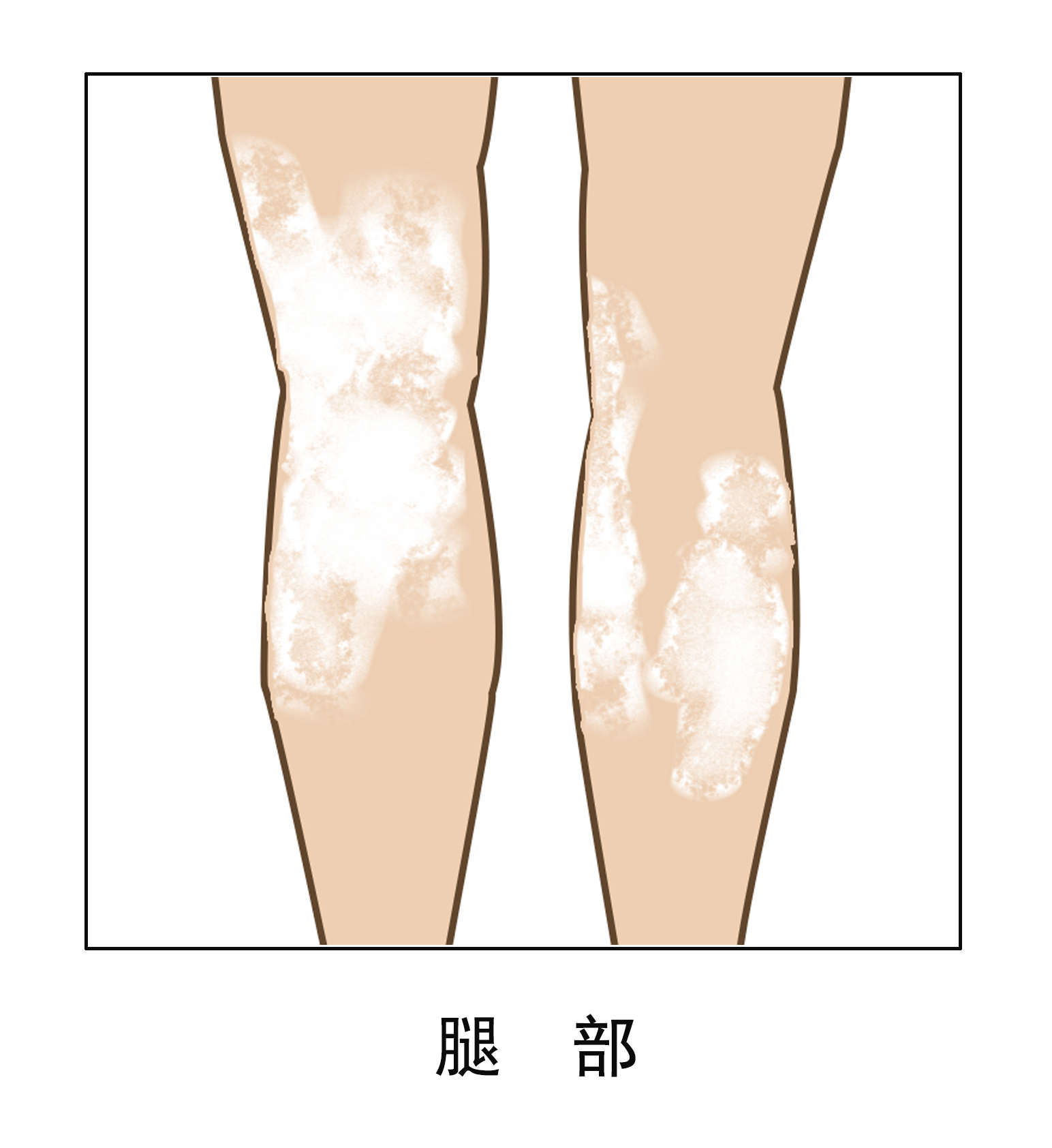 小腿白癜风应当如何治疗